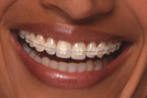 علم الأنساب عربة روديو  تقويم الاسنان | عيادات الدكتور احمد ابو حمده لطب الاسنان